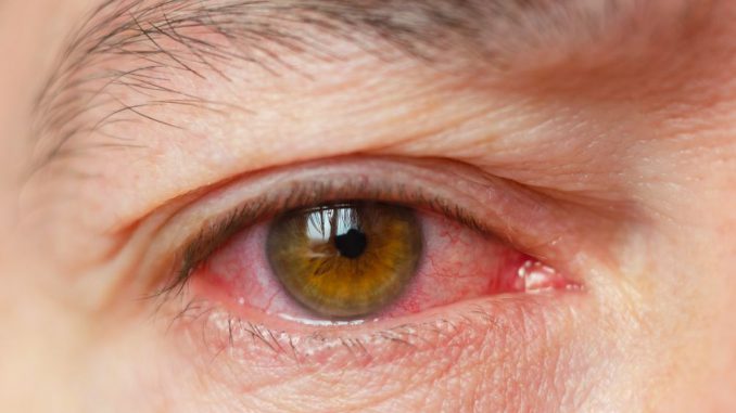 uveitis